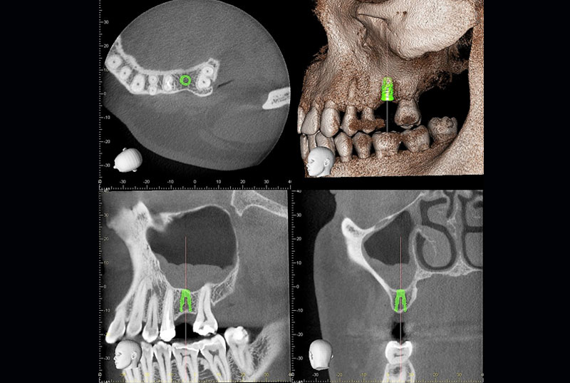 Radiología Yangüela radiografía de maxilar